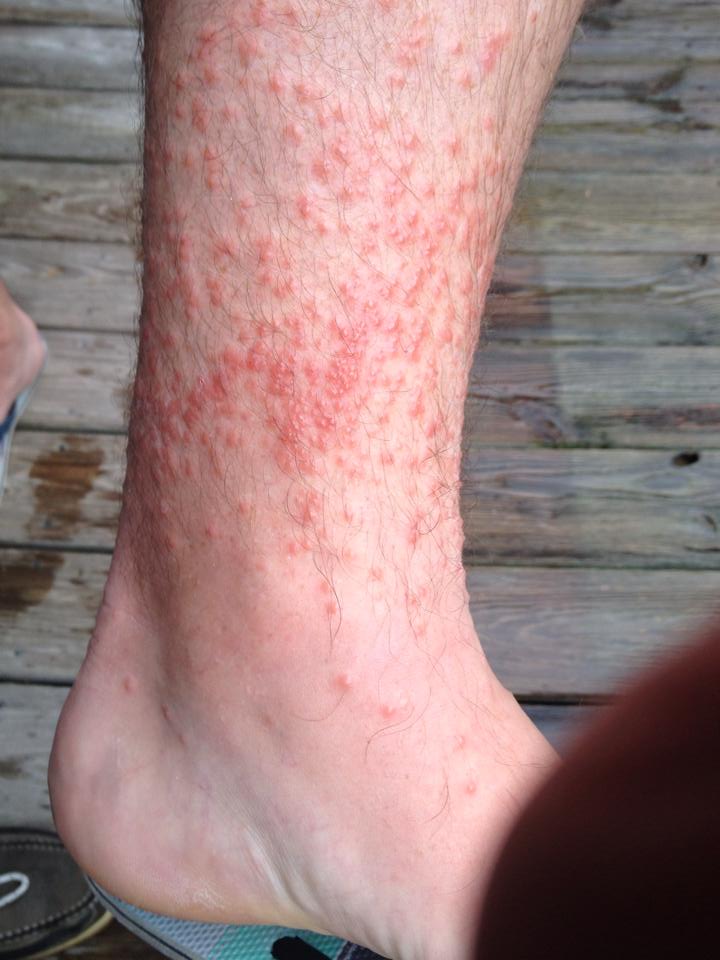 Chiggers! Chiggers! And more Chiggers! Please make them stop ...